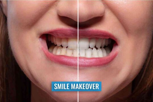 dental makeover